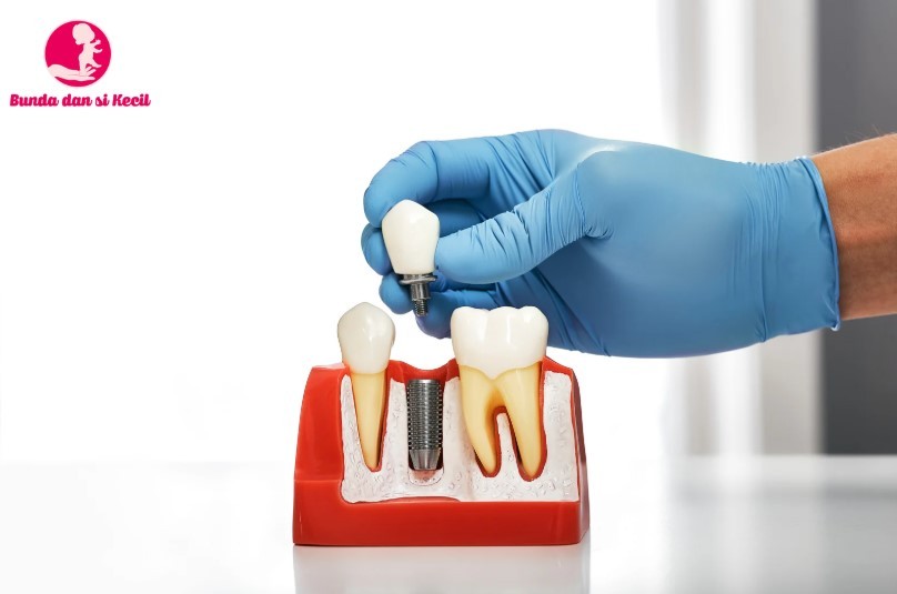 Do’s and Don’ts Setelah Implan Gigi: Panduan Lengkap untuk Pemulihan yang Optimal